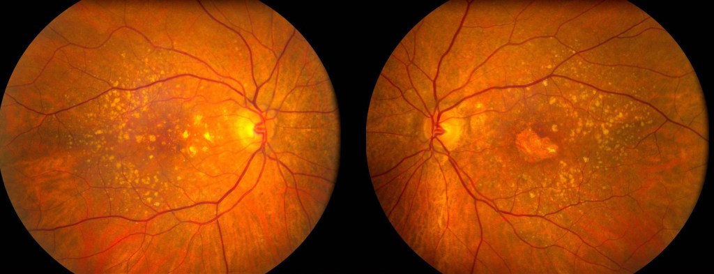 Macular degeneration is a potentially blinding eye disease, commonly found in developed countries such as the U.K.